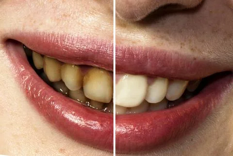 Difference dirty and clean teeth of mouth smiling girl Stockfoto's