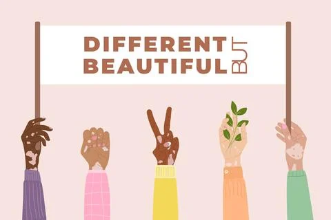 Different but beautiful concept. Diversity hands with vitiligo skin disease.. Stock Illustration
