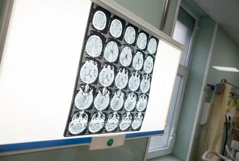 Different brain activity is seen on a x-ray screen in a neurology clinic in t Stock Photos