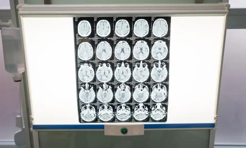 Different brain activity is seen on a x-ray screen in a neurology clinic in t Stock Photos