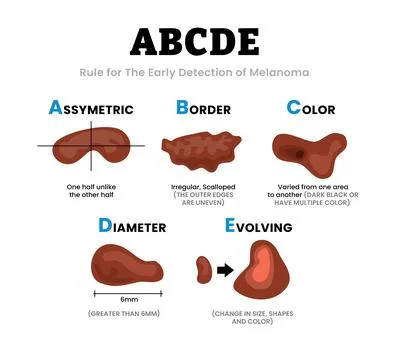 Different characteristics of skin damage. ABCDE Rule for the early detectio.. Stock Illustration