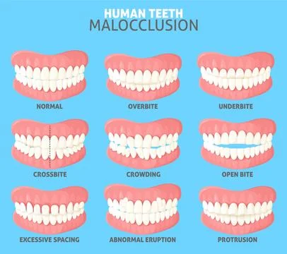 Different human teeth malocclusion types front view set Stock Illustration
