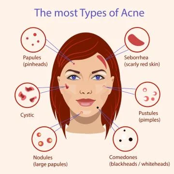 Different type of acne. Vector Illustration with skin problems. Stock Illustration