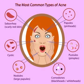 Different type of acne. Vector Illustration with skin problems. woman face Stock Illustration