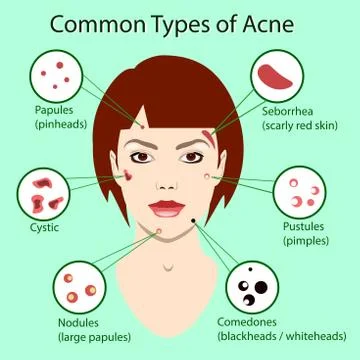 Different type of acne. Vector Illustration with skin problems. woman face Stock Illustration