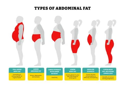 Different types of abdominal fat set collection, body fat healthcare poster.. Stock Illustration