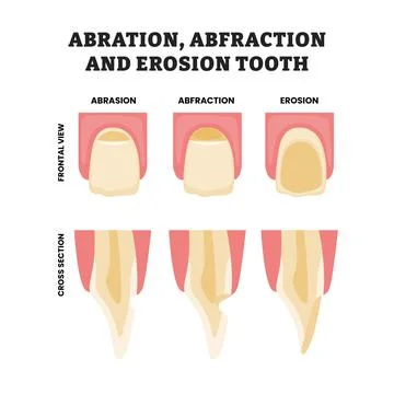 Different types of abrasion, abfraction and erosion tooth, educational medi.. Stock Illustration