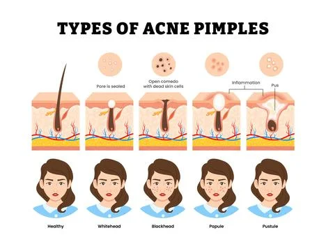 Different types of acne pimples type with girl or woman character. Labeled .. Stock Illustration