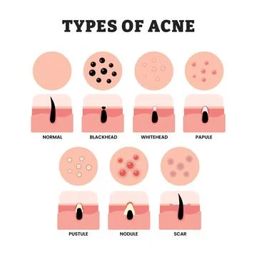 Different types of acne types, educational medical poster design healthcare.. Stock Illustration
