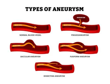 Different types of aneurysm types set collection. Abnormal artery in aorta .. Stock Illustration
