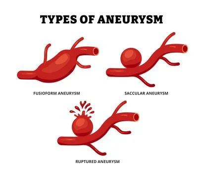 Different types of aneurysm types set collection. Abnormal artery in aorta .. Stock Illustration