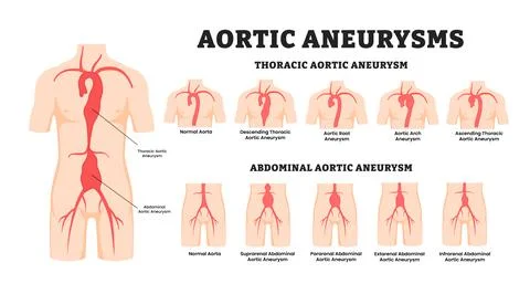 Different types of aortic aneurysm types, educational medical poster design.. Stock Illustration