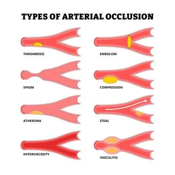 Different types of arterial occlusion types. Vascular disease. Artery obstr.. Stock Illustration