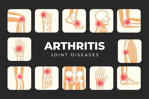 Different types of Arthritis set infographic diagram poster, Joint disease .. Stock-Illustration