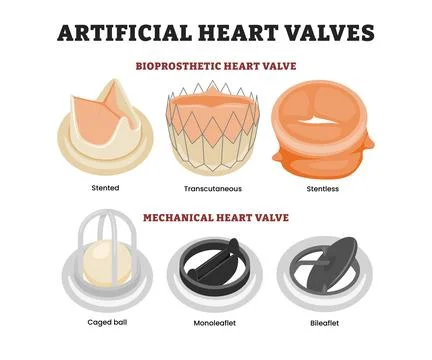 Different types of artificial heart valve, educational medical poster desig.. Stock Illustration