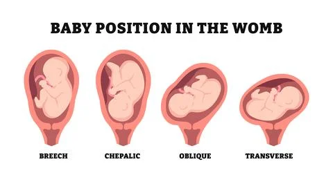 Different types of baby position in the womb during pregnancy, educational .. Stock Illustration