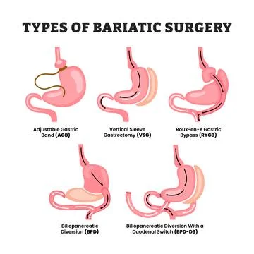 Different types of Bariatric Surgery Types, educational medical poster desi.. Stock Illustration