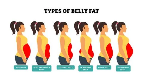 Different types of belly fat set collection, body fat healthcare poster des.. Stock Illustration