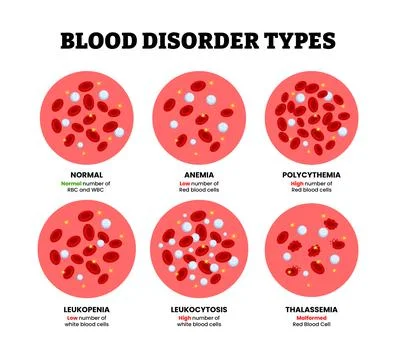 Different types of blood disorder types, Anemia, polycythemia, leukopenia,l.. Stock Illustration