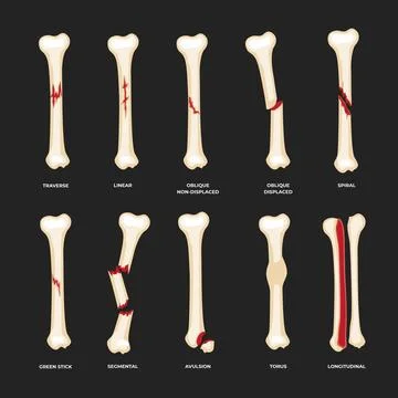 Different types of bone fracture set collection, Diagram of leg fracture in.. Stock Illustration