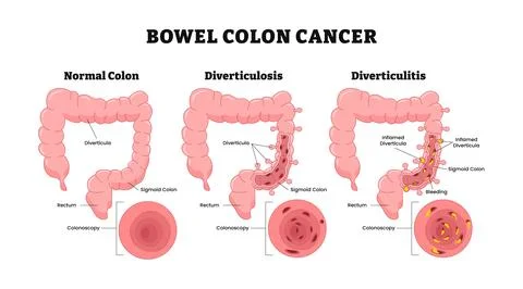 Different types of Bowel colon cancer, labeled healthy colon, diverticulosi.. Stock Illustration