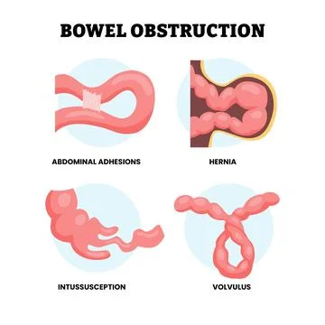 Different types of bowel obstruction types. Labeled abdominal adhesions, he.. Stock-Illustration