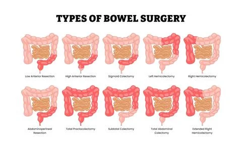 Different types of bowel surgery types, educational medical poster diagram .. Stock Illustration