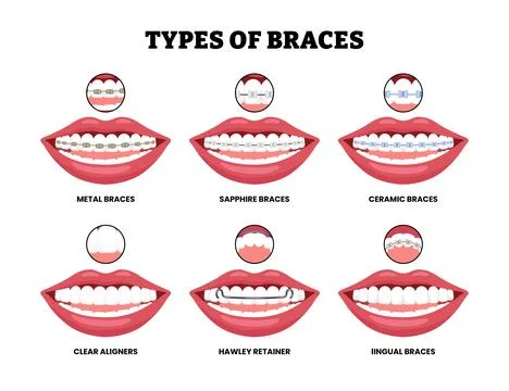 Different types of braces types set collection. Dental bracket teeth retain.. イラスト素材
