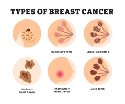 Different types breast cancer types, educational medical poster design heal.. Stock Illustration