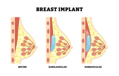 Different types of breast implant types with side view, educational medical.. Illustrazione stock