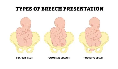 Different types of breech presentation types, educational medical poster de.. Stock Illustration
