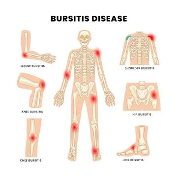 Different types of bursitis as medical body joints inflammation list diagra.. 스톡 일러스트