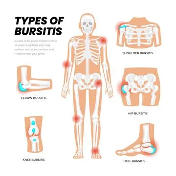 Different types of bursitis as medical body joints inflammation list diagra.. 스톡 일러스트