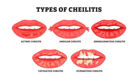 Different types of cheilitis types, educational medical poster design healt.. Stock Illustration
