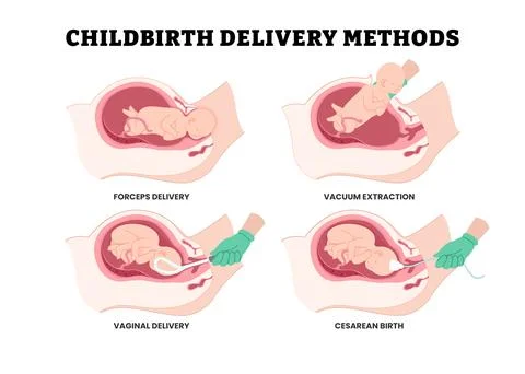 Different types of childbirth delivery methods steps procedure with doctor,.. Stock Illustration