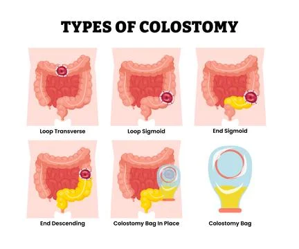 Different types of colostomy types set collection. Labeled loop transverse,.. Illustrazione stock