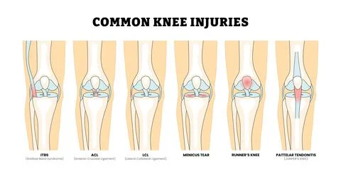 Different types of common knee injury types, educational medical poster des.. Stock Illustration