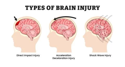 Different types of damaged human brain injury types, educational medical po.. Stock Illustration