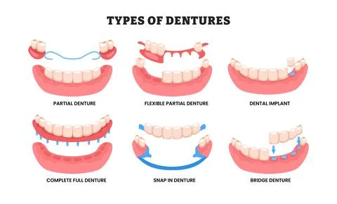 Different types of dentures, dental prosthesis types, educational medical p.. Stock Illustration