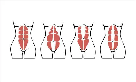 Different types of Diastasis Stock Illustration