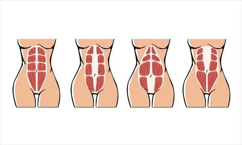 Different types of Diastasis Stock Illustration