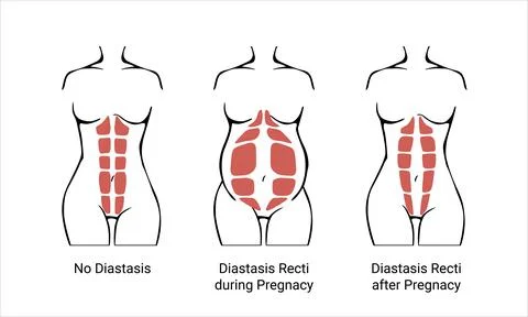 Different types of Diastasis Stock Illustration