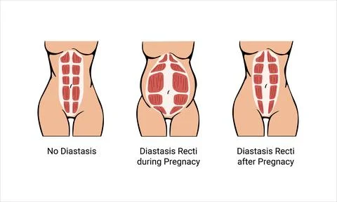 Different types of Diastasis Stock Illustration