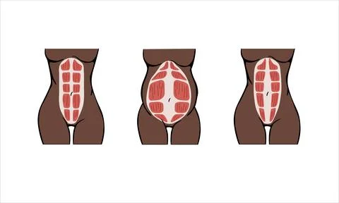 Different types of Diastasis Stock Illustration