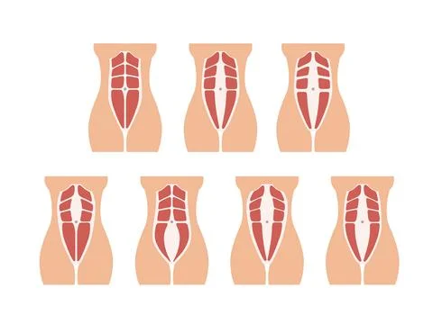 Different types of Diastasis Stock Illustration