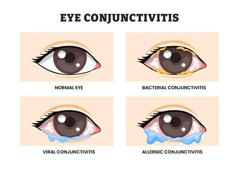 Different types of Eye Conjunctivitis types, educational medical poster des.. Stock Illustration