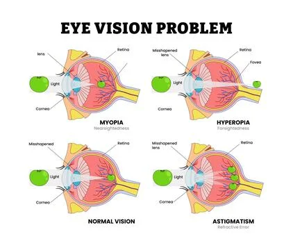Different Types of Eye Vision Problem, Eye Disease for Educational Medical .. Illustrazione stock
