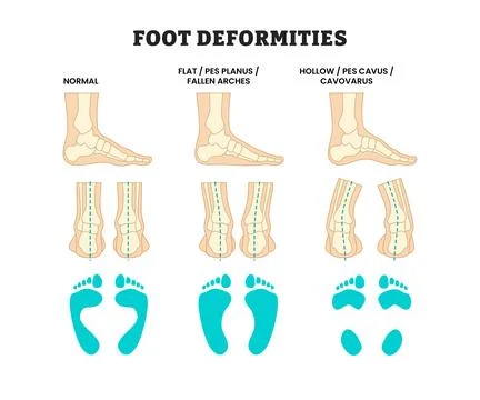 Different types of foot deformities types, educational medical poster desig.. Illustrazione stock