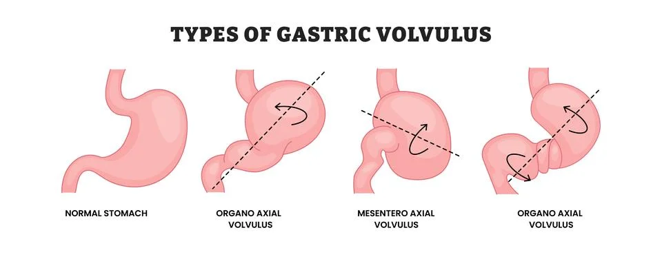 Different types of gastric volvulus types, educational medical poster desig.. Stock-Illustration