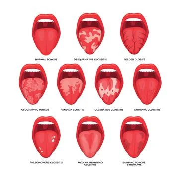 Different types of glossitis set collection, Diagram of tongue disease in d.. Stock Illustration